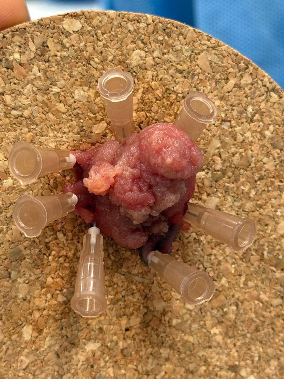 Precision Endoscopy in Early Cancer Care - image 1